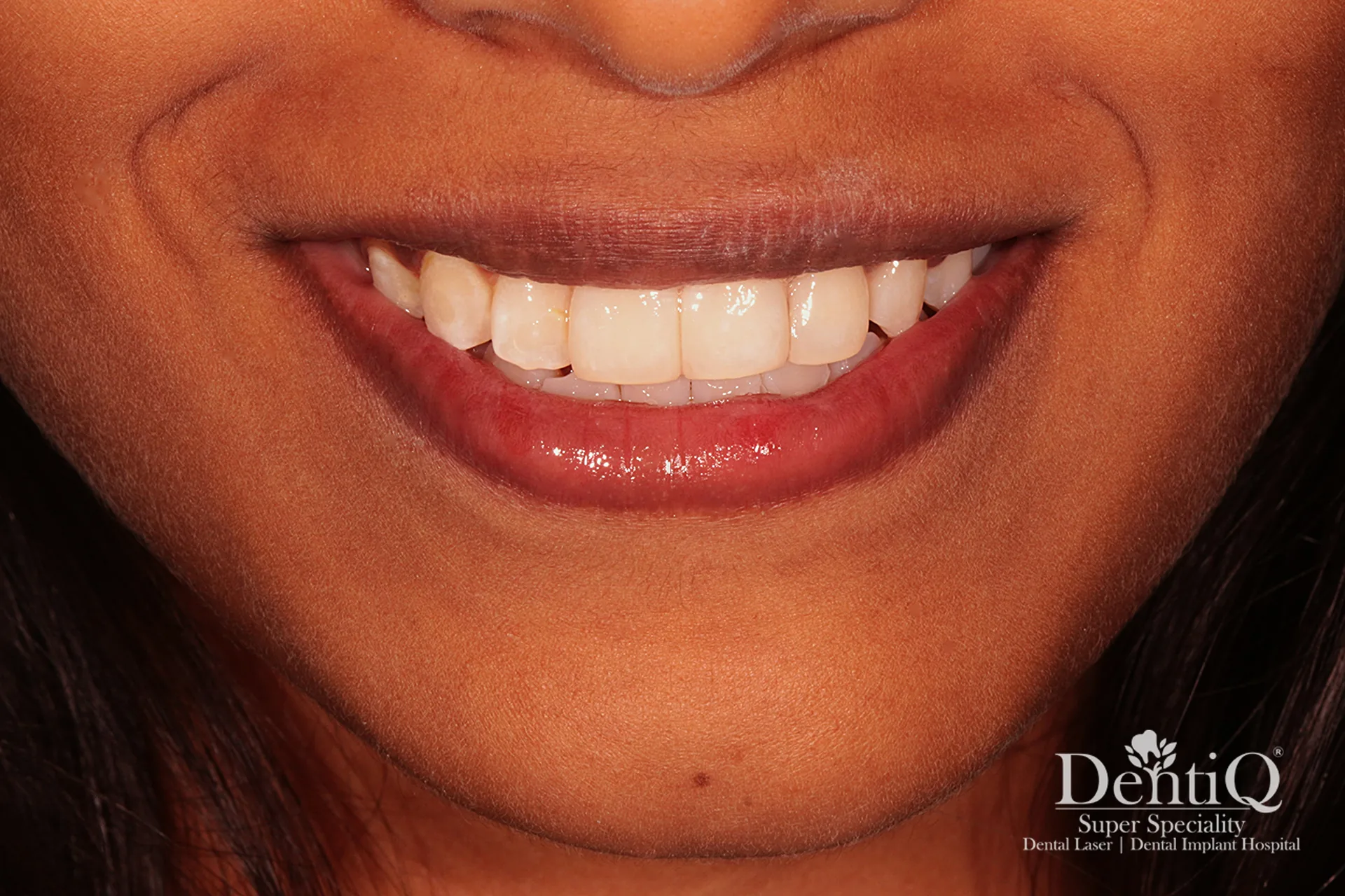 Full Smile Makeover - After